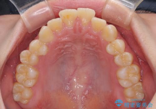 前歯が2本ない ワイヤー装置での抜歯矯正の治療前
