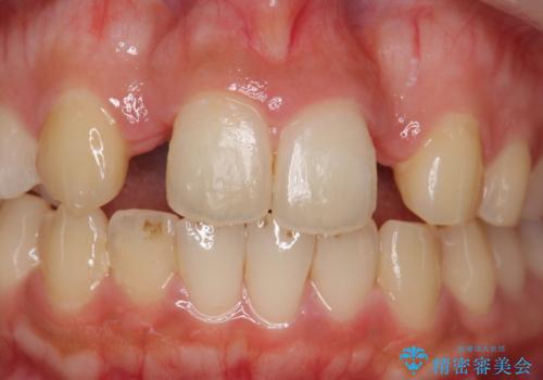 前歯の出っ歯とねじれ 短期間できれいに! 部分矯正とセラミックの組み合わせ治療の治療中