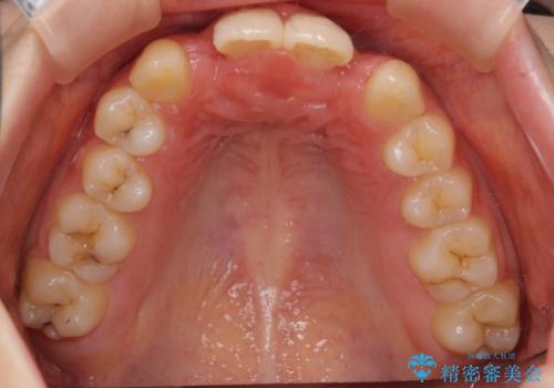 前歯の出っ歯とねじれ 短期間できれいに! 部分矯正とセラミックの組み合わせ治療の治療中