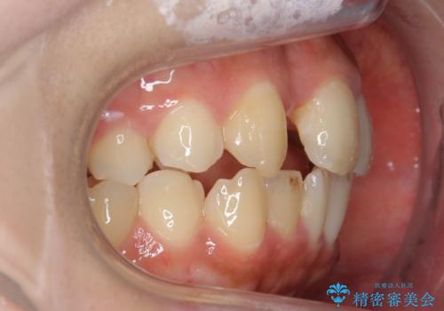 前歯の出っ歯とねじれ 短期間できれいに! 部分矯正とセラミックの組み合わせ治療の治療中