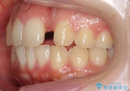 前歯の出っ歯とねじれ 短期間できれいに! 部分矯正とセラミックの組み合わせ治療の治療中