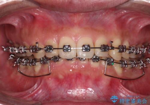 【モニター】前歯に隙間ができるほどのディープバイト ワイヤー装置で負担の少ない咬み合わせにの治療中