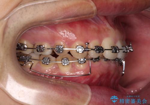 【モニター】前歯に隙間ができるほどのディープバイト ワイヤー装置で負担の少ない咬み合わせにの治療中