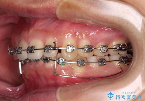 【モニター】前歯に隙間ができるほどのディープバイト ワイヤー装置で負担の少ない咬み合わせにの治療中