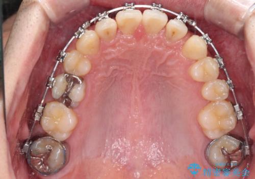 【モニター】前歯に隙間ができるほどのディープバイト ワイヤー装置で負担の少ない咬み合わせにの治療中