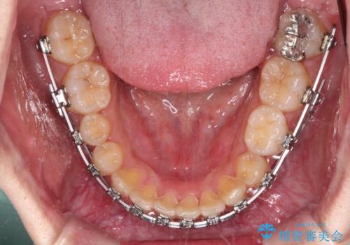 【モニター】前歯に隙間ができるほどのディープバイト　ワイヤー装置で負担の少ない咬み合わせにの治療中