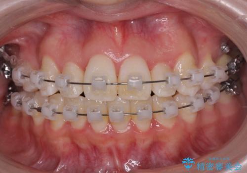難症例 奥歯がかみ合っていない 歯並び矯正で別人にの治療中
