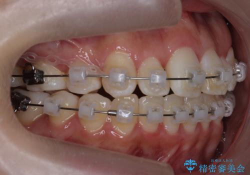 難症例 奥歯がかみ合っていない 歯並び矯正で別人にの治療中