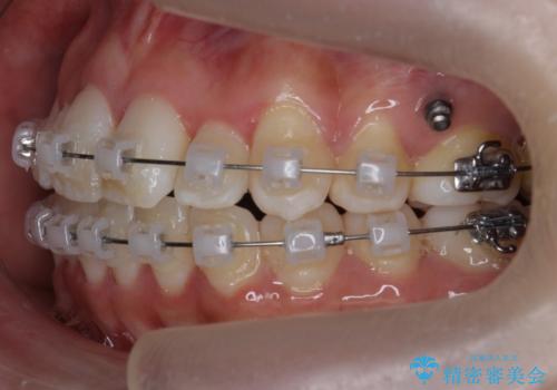 難症例 奥歯がかみ合っていない 歯並び矯正で別人にの治療中