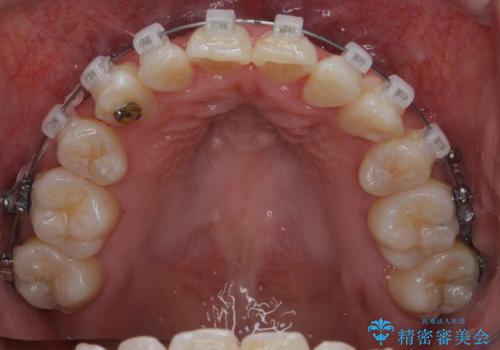 難症例 奥歯がかみ合っていない 歯並び矯正で別人にの治療中