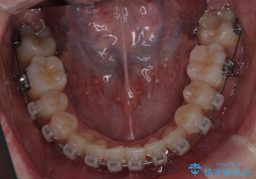 難症例　奥歯がかみ合っていない　歯並び矯正で別人にの治療中