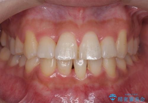 前歯のがたつき、中に入ってしまっている 部分矯正で低予算での治療後