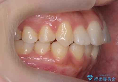 前歯のがたつき、中に入ってしまっている 部分矯正で低予算での治療後