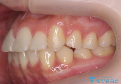 前歯のがたつき、中に入ってしまっている 部分矯正で低予算での治療後