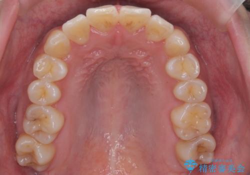 前歯のがたつき、中に入ってしまっている 部分矯正で低予算での症例 治療後