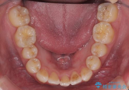 前歯のがたつき、中に入ってしまっている 部分矯正で低予算での治療後
