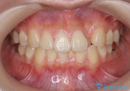 正中のズレ、引っ込んだ前歯の矯正の症例 治療前