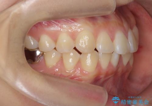 正中のズレ、引っ込んだ前歯の矯正の治療前