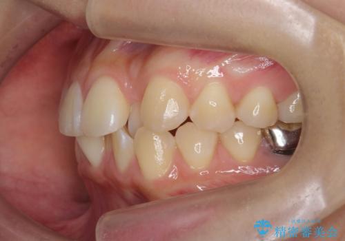 正中のズレ、引っ込んだ前歯の矯正の治療前