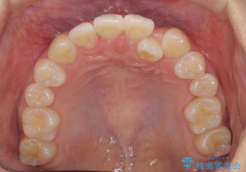 正中のズレ、引っ込んだ前歯の矯正の治療前