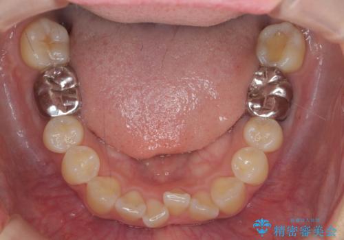 正中のズレ、引っ込んだ前歯の矯正の治療前