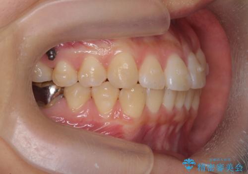 正中のズレ、引っ込んだ前歯の矯正の治療前