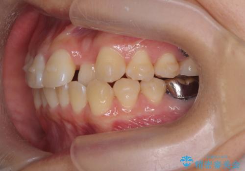 正中のズレ、引っ込んだ前歯の矯正の治療前