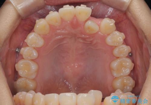 正中のズレ、引っ込んだ前歯の矯正の治療前