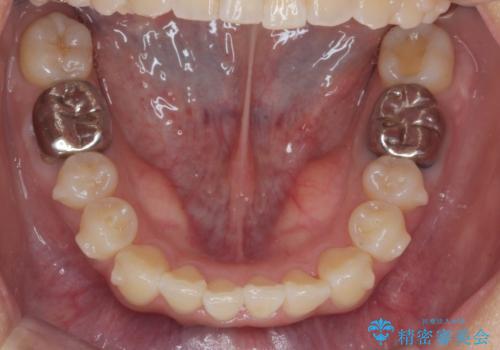 正中のズレ、引っ込んだ前歯の矯正の治療前
