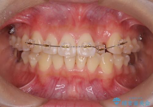 正中のズレ、引っ込んだ前歯の矯正の治療中