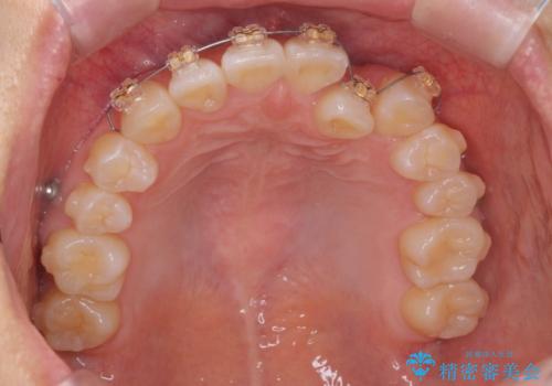 正中のズレ、引っ込んだ前歯の矯正の治療中