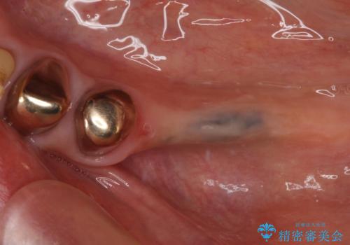 入れ歯を使いたくない 細い骨にインプラントを埋入した補綴治療の症例 治療前