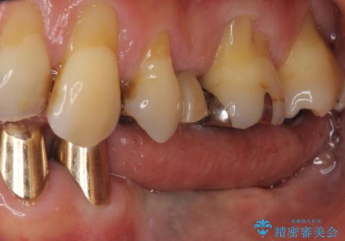 入れ歯を使いたくない　細い骨にインプラントを埋入した補綴治療の治療前
