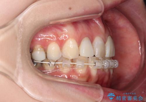 大きなむし歯と欠損をセラミックに　部分矯正を併用した総合歯科治療の治療中