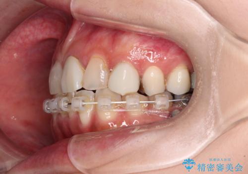 大きなむし歯と欠損をセラミックに 部分矯正を併用した総合歯科治療の治療中