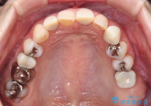 大きなむし歯と欠損をセラミックに 部分矯正を併用した総合歯科治療の治療中