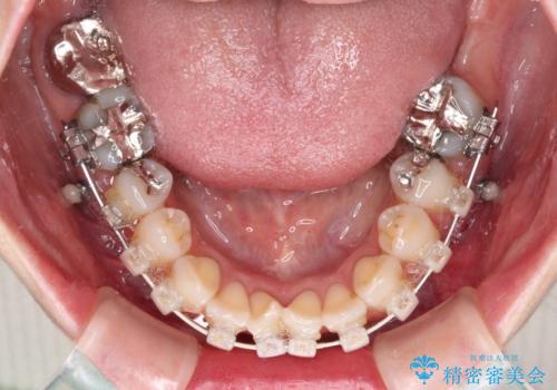 大きなむし歯と欠損をセラミックに　部分矯正を併用した総合歯科治療の治療中