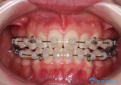 【モニター】口が閉じにくい 膨らんだ口元を抜歯矯正ですっきりとの治療中
