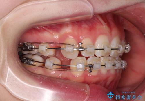 【モニター】口が閉じにくい 膨らんだ口元を抜歯矯正ですっきりとの治療中