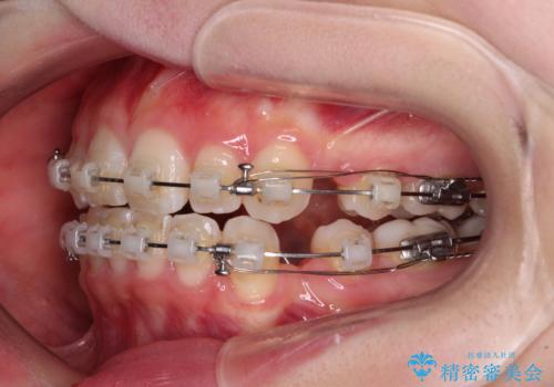 【モニター】口が閉じにくい 膨らんだ口元を抜歯矯正ですっきりとの治療中