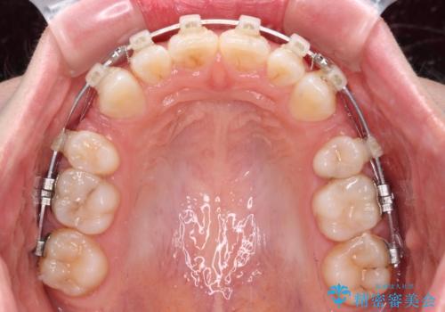 【モニター】口が閉じにくい 膨らんだ口元を抜歯矯正ですっきりとの治療中