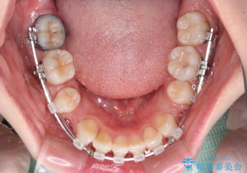 【モニター】口が閉じにくい 膨らんだ口元を抜歯矯正ですっきりとの治療中