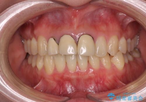 前歯の黒い縁を綺麗にしたい　前歯のオールセラミックの治療前