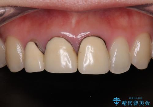前歯の黒い縁を綺麗にしたい　前歯のオールセラミックの症例 治療前