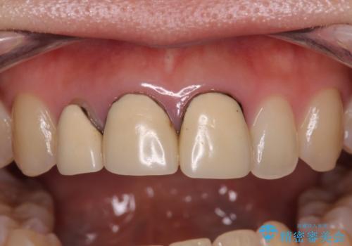 前歯の黒い縁を綺麗にしたい 前歯のオールセラミックの治療前