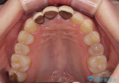 前歯の黒い縁を綺麗にしたい 前歯のオールセラミックの治療前