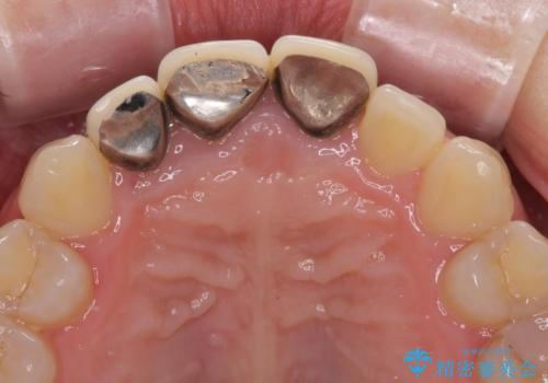 前歯の黒い縁を綺麗にしたい 前歯のオールセラミックの治療前