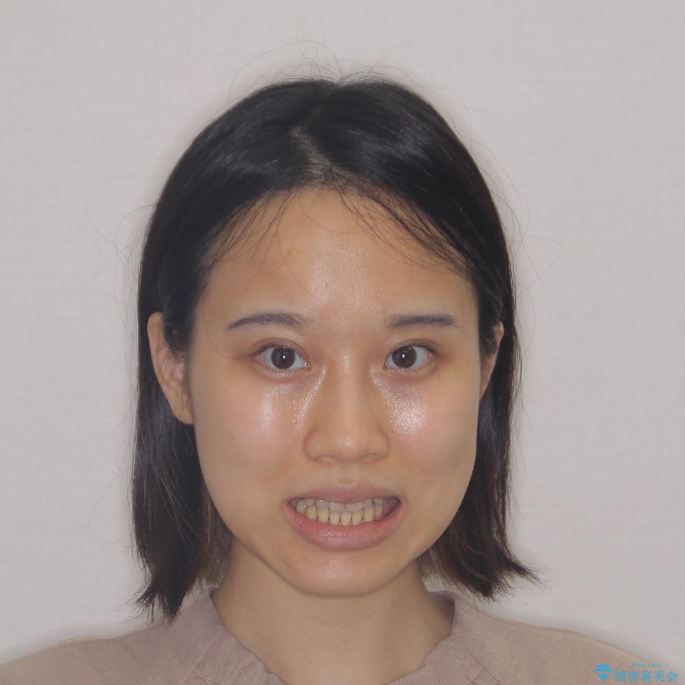【モニター】開咬を治したい インビザラインによる矯正治療の治療前(顔貌)