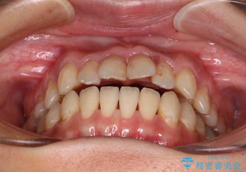 【モニター】開咬を治したい インビザラインによる矯正治療の治療前