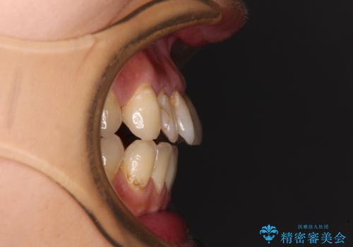 【モニター】開咬を治したい インビザラインによる矯正治療の治療前